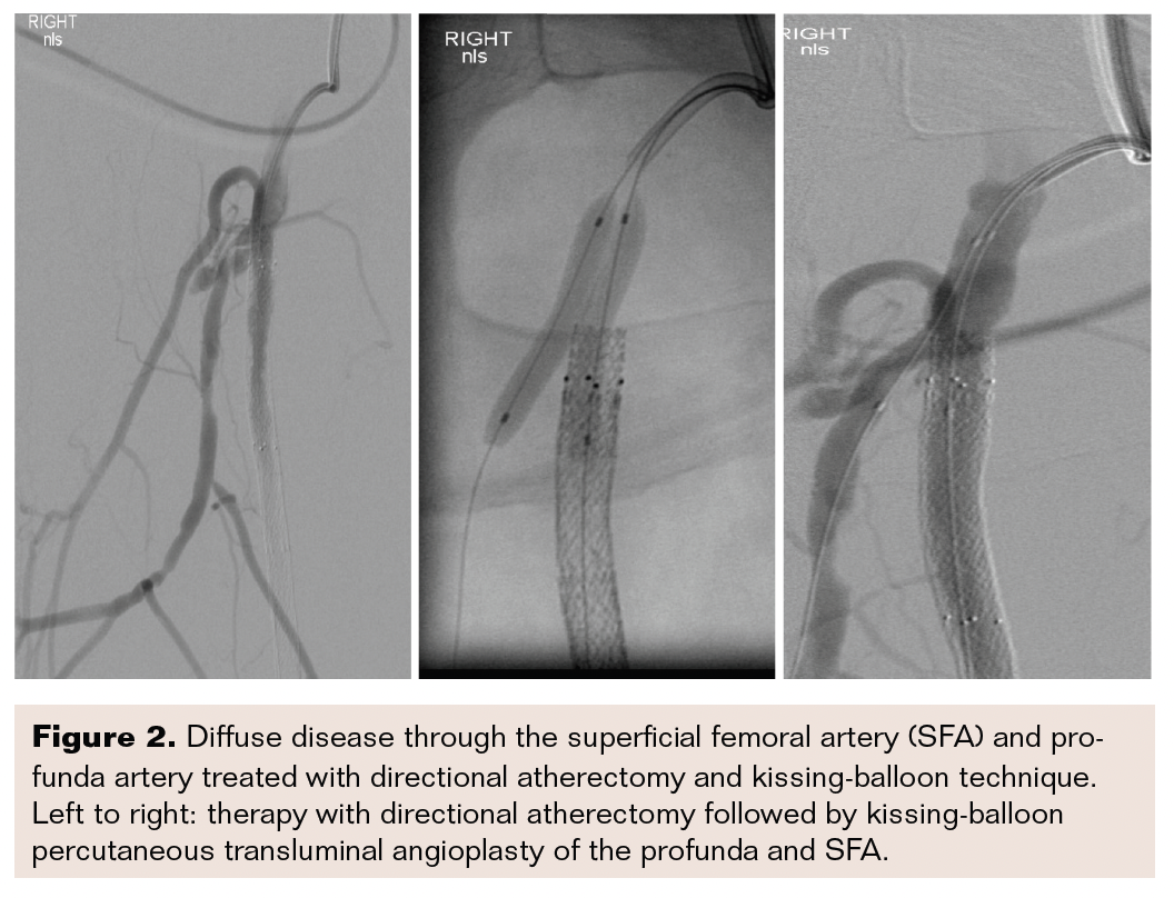 CFA, Profunda, and SFA Disease Vascular Disease Management